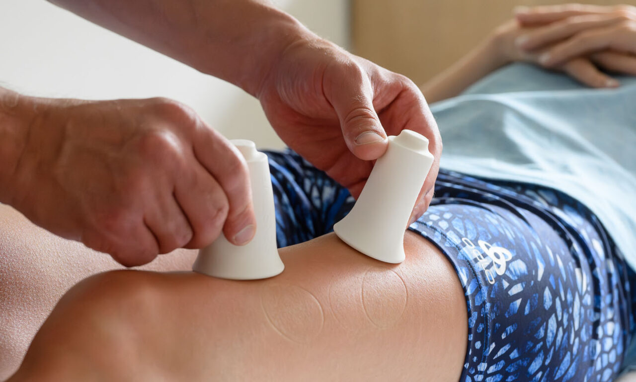 Therapeutische Schröpfmassage mit Silikon-Cups am Oberschenkel zur Förderung der Durchblutung und Faszienbehandlung im Bärenhof.